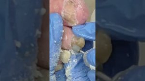 Практика "Обработка утолщенных ногтей".