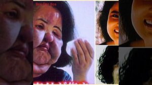 ТОП-5 САМЫХ СТРАШНЫХ ПОСЛЕДСТВИЙ ПОСЛЕ ПЛАСТИКИ