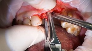 12 января. Удаление радикулярной кисты верхней челюсти. Эпизод 1.