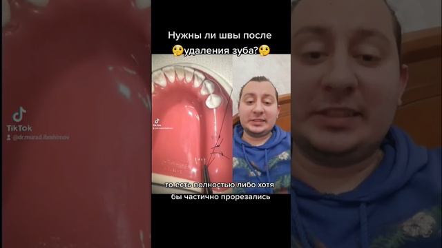 Всегда ли нужны швы?🤔🦷 #дантист #dentist #стоматолог #швы #удалениезубовмудрости #стоматология #зуб