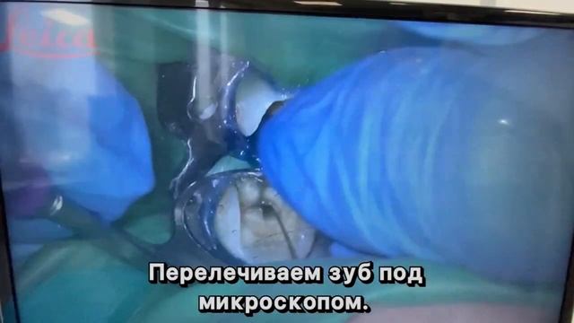 Лечение под микроскоппом. Стоматолог Волкова О.Д. "Домостом" смотреть онлайн