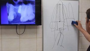 Правильное сверление, профилактика ятрогении при подготовке ложа для импланта..mp4