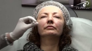 Коррекция иглой уголков губ - важные нюансы