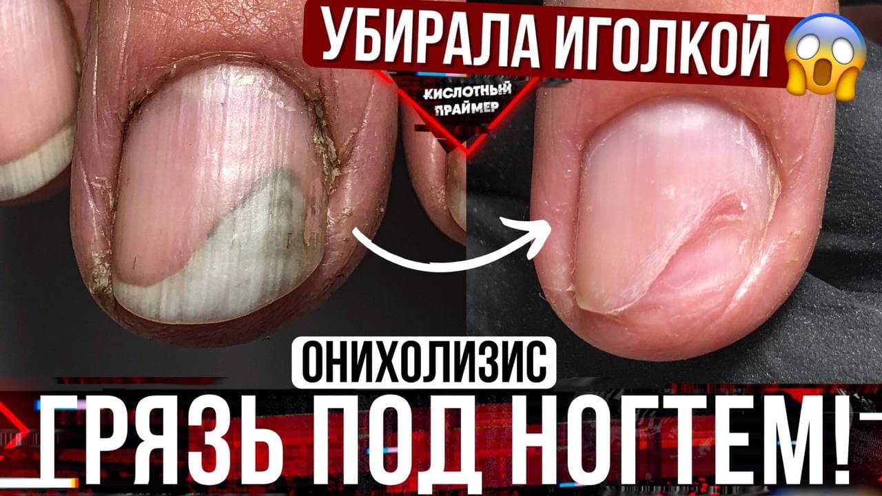 ⚡ДОКОВЫРЯЛАСЬ ИГОЛКОЙ ДО ОНИХОЛИЗИСА!? Зачистка онихолизис ногтей на руках?