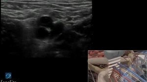 3D-пособие: Катетеризация бедренной артерии под контролем ультразвука