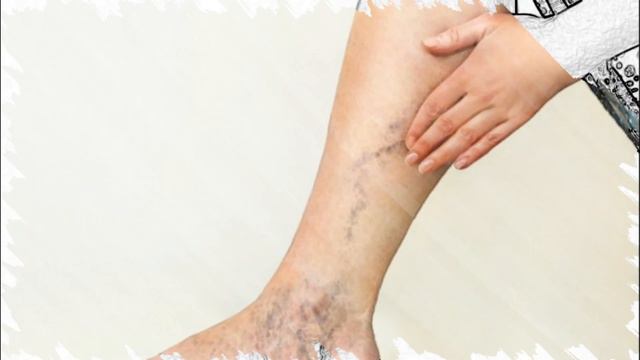 Избавьтесь От Варикозного Расширения Вен. Яблочный Уксус Пожет При Варикозе Вен