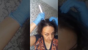 Фракционная мезотерапия волос.