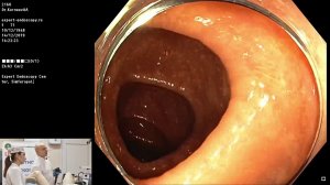 06 Корнеев АА живая демонстрация Экспертная колоноскопия Удаление полипов