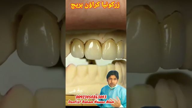 Zrconia Bridge and Crown| Dentist |