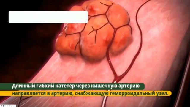 Эндоваскулярная эмболизация геморройных узлов