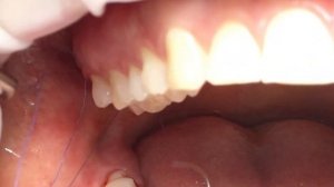 Швидке видалення зуба / Fast Tooth Extraction.