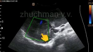 Первичный рак печени УЗИ