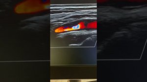 Практическое занятие. УЗИ брахиоцефальных артерий. Стеноз ВСА. О.Л. Ерошенко.