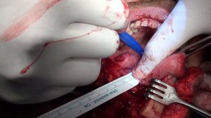 рак языка - median mandibulotomy Tongue cancer