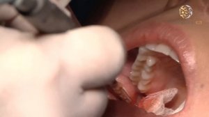 Удаление комков Биша. Клиника СЛ