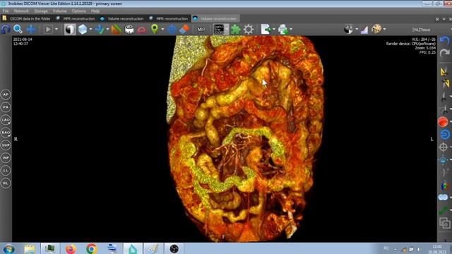 ВНУТРЕННИЕ ГРЫЖИ  INTERNAL HERNIAS .