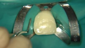 Реставрация передних зубов часть 1