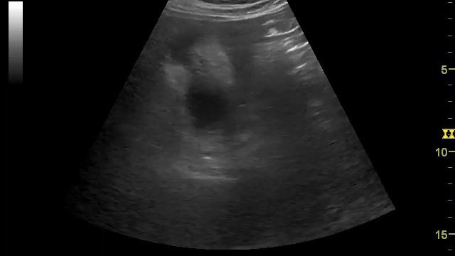 acute cholecystitis острый холецистит смотреть онлайн