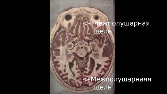 Анатомия головного мозга человека (поперечные срезы)
