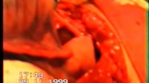 Кистэктомия № 8 Большая киста правого яичника