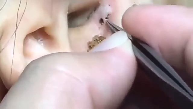 Удаление чёрных точек
