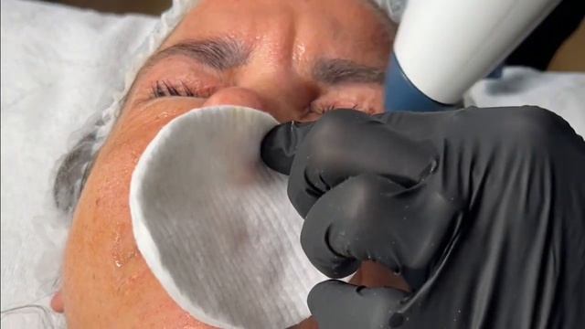 Zabieg coolifting 2.0 - Młodsza o kilka lat w 5 minut… смотреть онлайн