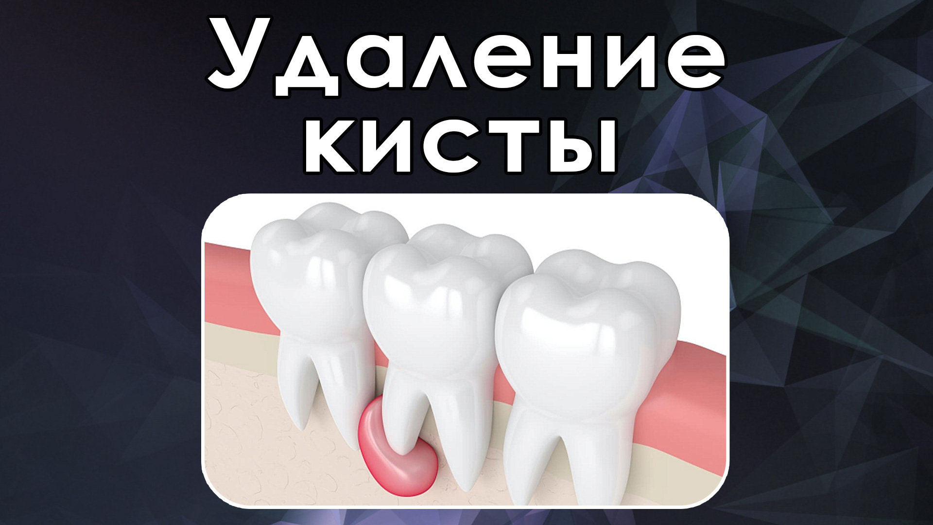 Цистэктомия нижней челюсти