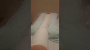 Перелом ноги. Перелом ладьевидной кости. Гипс.
