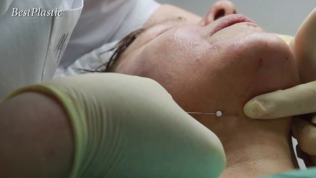 Процедура нити (1)