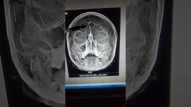 P.N.S x-ray //paranasal .sinus .skull. and radiography