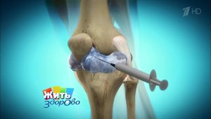 Остеоартроз колена. Жить здорово! Фрагмент выпуска от 29.01.2016