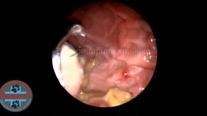 Эндоскопическое удаление инородного тела (мяч-попрыгун) из желудка собаки.
