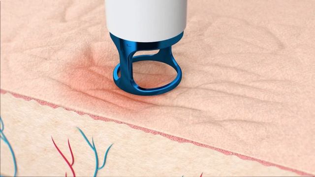 ClearLift смотреть онлайн