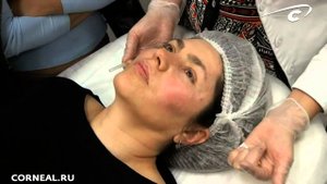 Линейная техника. Биоревитализация. Essel lab.