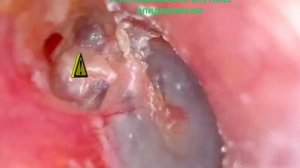 эпитимпанит. хронический отит. это лечиться хирургически