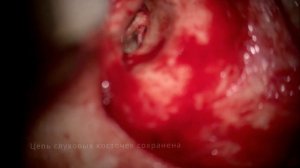 Врожденная холестеатома