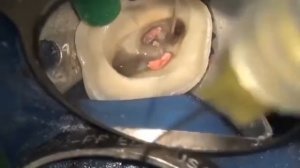 Вкладка на зуб, изготовление фиксация и обработка.