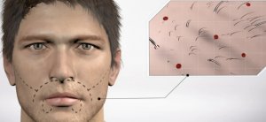 Как проходит пересадка бороды: этапы процедуры.