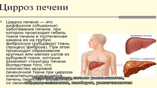 Четыре стадии цирроза печени