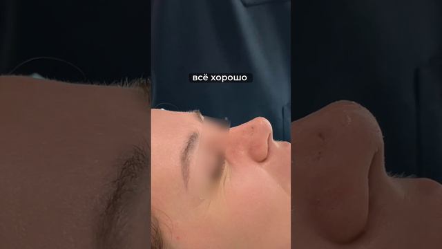 Выполнена структурная септоринопластика в области кончика и сохраняющая в области спинки носа.
