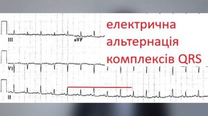 Вольтаж ЕКГ. Коли вважати зниженим