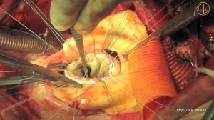 Протезирование аорт. клапана и восх. отдела аорты по  Бенталла-ДеБоно. Протезирование дуги аорты.