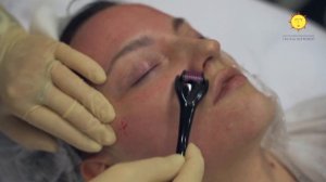 Дермароллер. Микроигольчатая терапия.