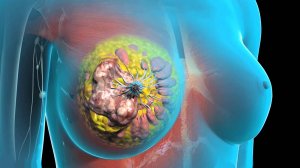 Новообразование молочной железы.