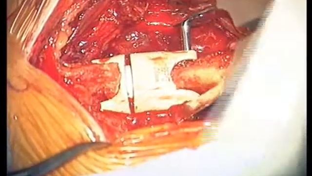 Межостистая стабилизация Live Surgical Technique