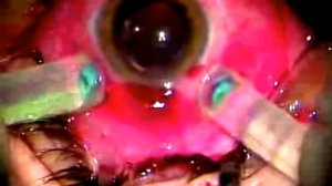 Способ быстрого удаления силикона из глаза