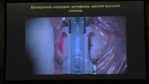 Имплантация искусственной радужки в афакичный глаз с врождённой аниридией