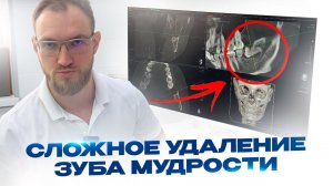 Сложное Удаление зуба мудрости расположенного горизонтально. Врач - Стоматолог Стас Белоус Ульяновск