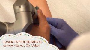 Värvilise tatoveeringu eemaldamine Удаление цветных татуировок Colour tattoo removal