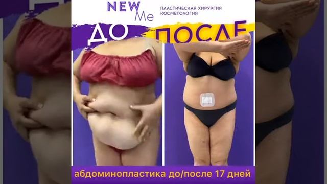 Абдоминопластика /Осин Максим Александрович смотреть онлайн